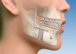 متخصص جراحی فک،دهان،صورت از (جراحی فک و زاویه دار کردن صورت) میگوید!