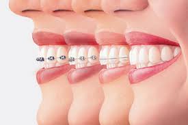 ارتودنسی (Orthodontic) و متخصص ارتودنسی را بهتر بشناسیم!