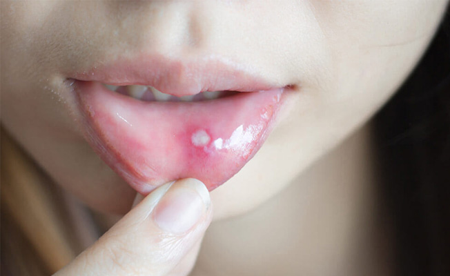 برای درمان آفت دهان به چه دکتری مراجعه کنیم