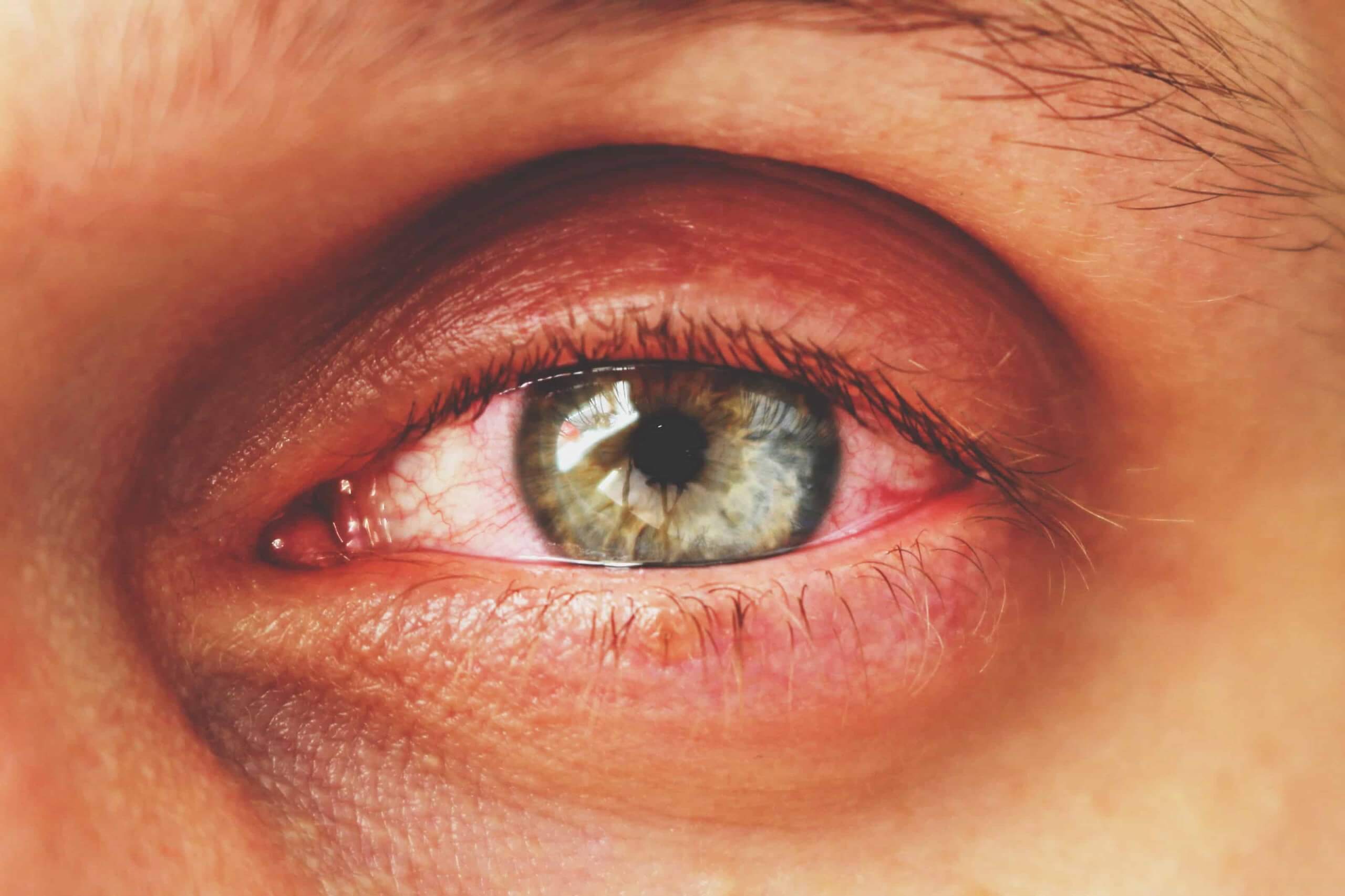 بیماری آلرژی چشم