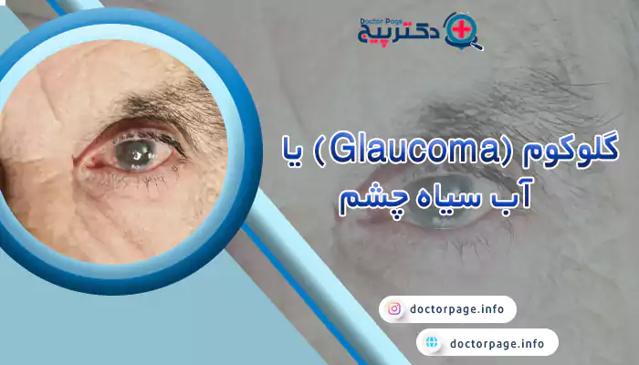 گلوکوم (Glaucoma) یا آب سیاه چشم