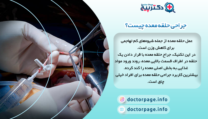 جراحی حلقه معده چیست؟