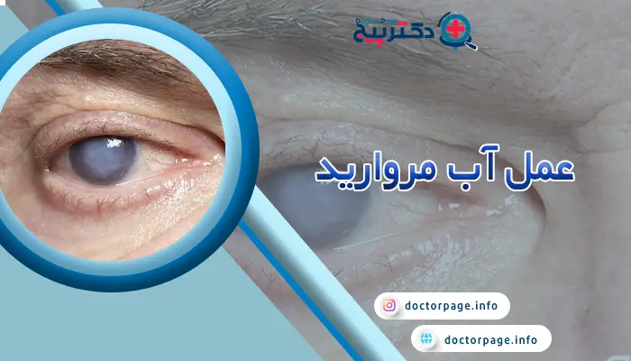 درمان آب مروارید چشم با عمل جراحی